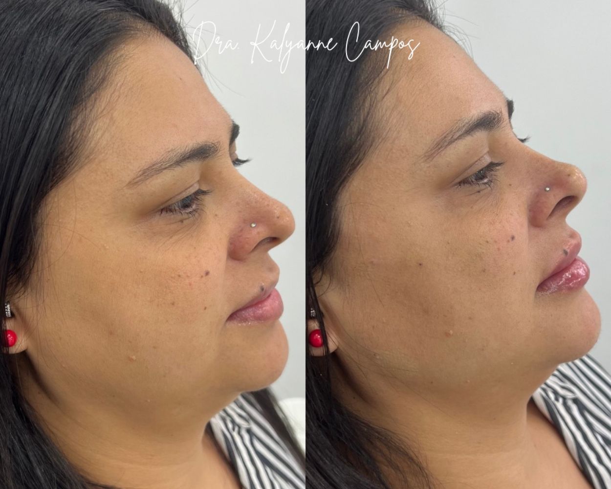 Clínica de Harmonização Facial em Santana SP