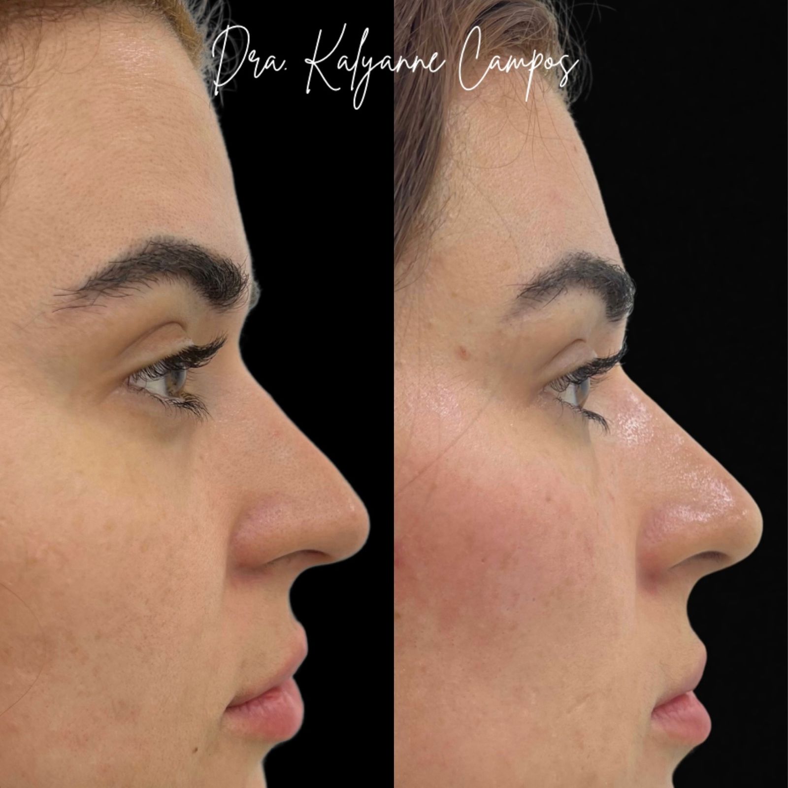Resultado de Preenchimento Labial Premium