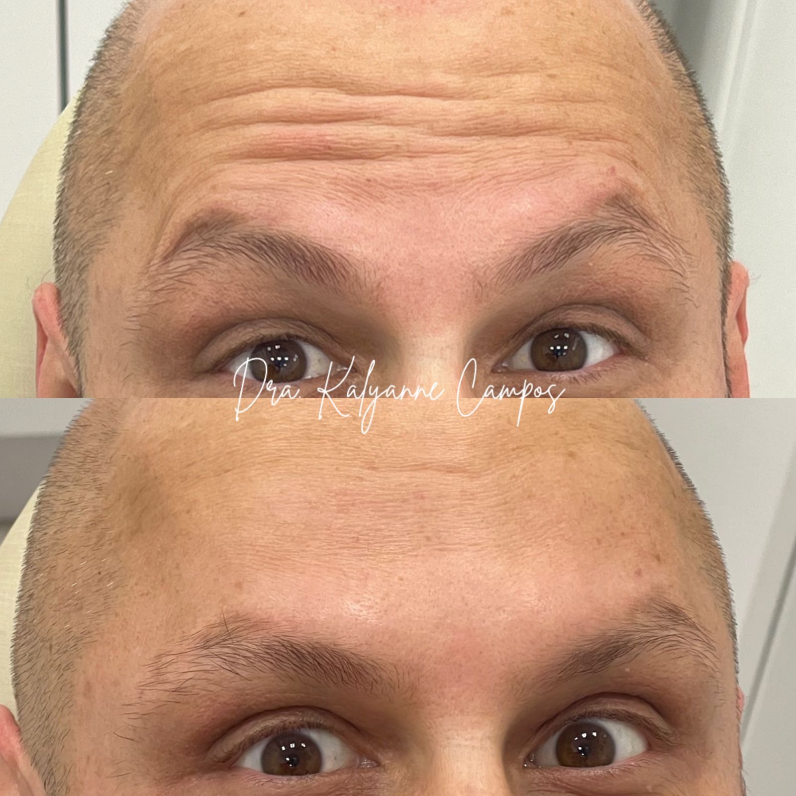 Rejuvenescimento Facial com Bioestimulador