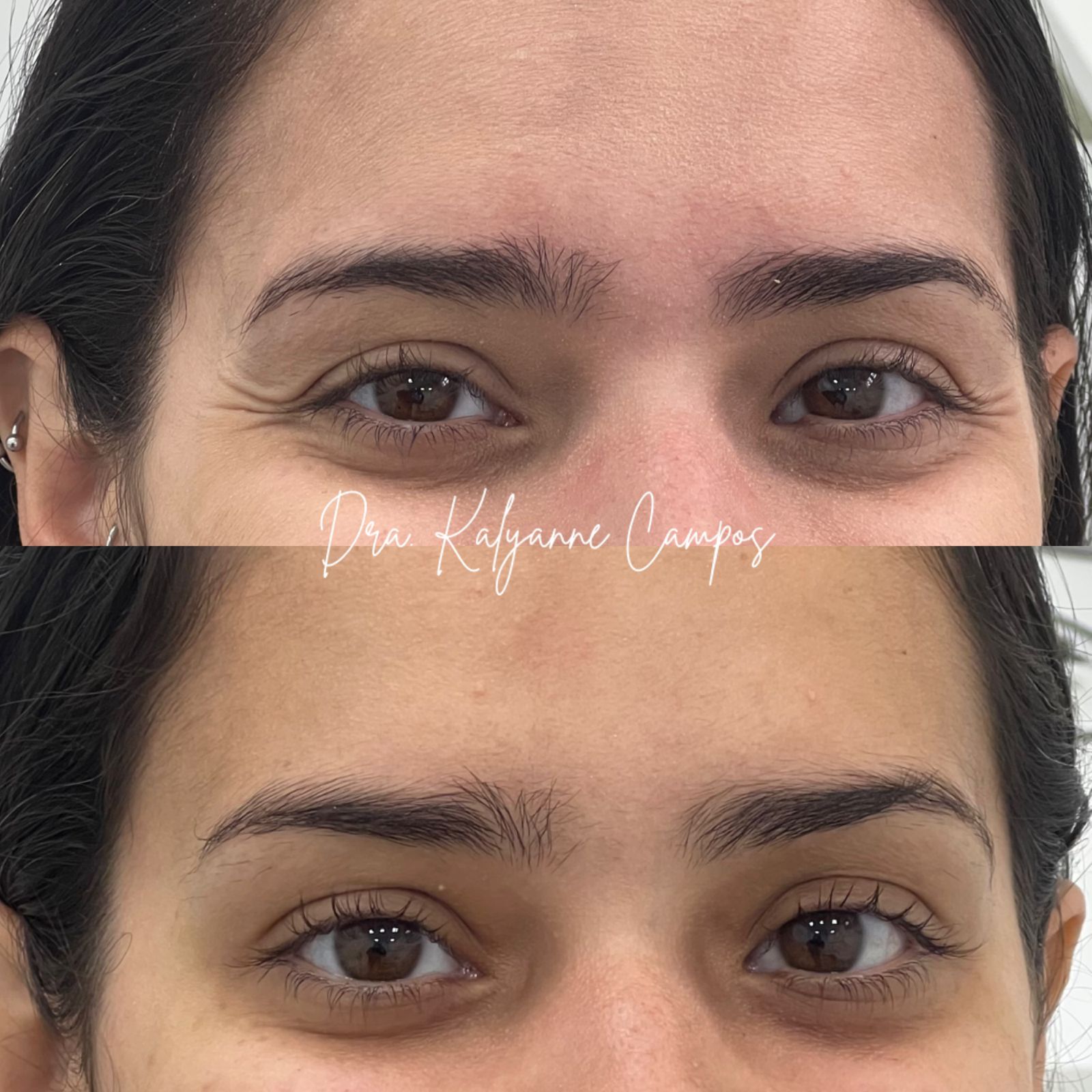 Preenchimento Labial 1ml Volume Sutil